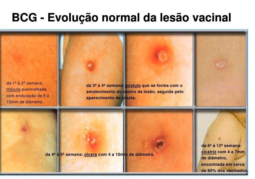 De 3 a 4 semanas surge um nódulo (caroço) no local De 4 a 5 semanas surge uma pústula