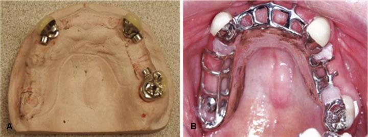 (B): Modelo com o enceramento de coroas. (Fonte: Liu et al., 2011) O implante na região distal da prótese maxilar serviu principalmente como um apoio vertical para a PPRIS.