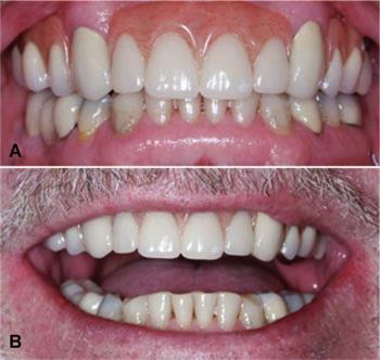 22 Figura 3: Implantes dentários com a seleção adequada de attachments para as coroas metalocerâmicas, após 6 meses da finalização do tratamento. (Fonte: Liu et al.
