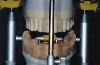 Entre as opções de tratamento oferecidas para o paciente, estavam: Confecção de uma nova prótese total mandibular, overdenture