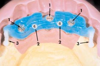 ) na região anterior da mandíbula entre os forames mentonianose uma prótese fixa anterior metalocerâmica foi confeccionada