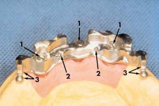 A B C D E F Figura 4: (A) Posição dos implantes instalados intra oral; (B) Montagem de implantes intra oral em ASA; (C)