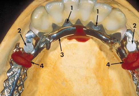 24 Figura 5: Prótese fixa implanto-suportada com a estrutura metálica da prótese parcial removível adaptada e capturada com resina autopolimerizante. (Fonte: Pellecchia & Emtiaz, 2000.