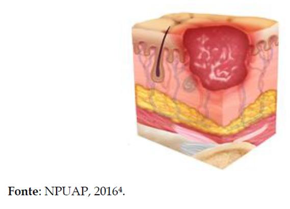 ESTÁGIO 2: ocorre perda da pele em sua espessura parcial com exposição
