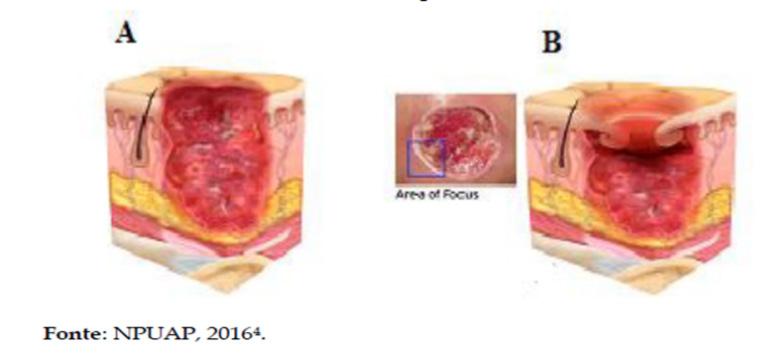ESTÁGIO 3: perda da pele em sua espessura total, que deixa a gordura visível e, frequentemente, com tecido de granulação e epíbole (lesão com bordas enroladas); esfacelo e/ou escara podem estar