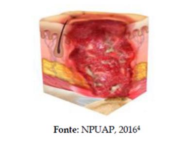 ESTÁGIO 4: apresenta perda da pele em sua espessura total e perda tissular com exposição ou palpação direta da fáscia, do músculo, do tendão, do ligamento, da cartilagem ou do osso; esfacelo e/ou