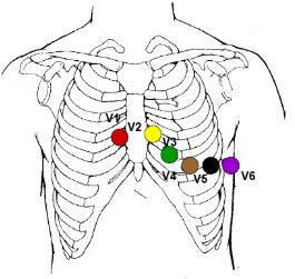 Figura 1 Posicionamento das derivações precordiais para a realização do exame ECG. João Pessoa, Paraíba 2018.