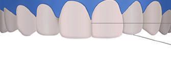 Evitar contato com dentes que não serão restaurados e com gengiva exposta. Aplicar uma camada uniforme de Adesivo Megabond no preparo.