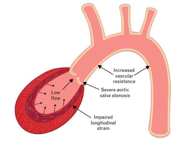 Leong et al., também verificaram que, frequências cardíacas altas, pressões sistólicas baixas e áreas de superfície corporal altas, estão associadas a baixo fluxo.