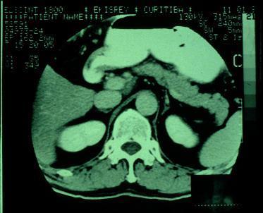 Pancreatitis