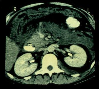 Pancreatitis Aguda Colecciones