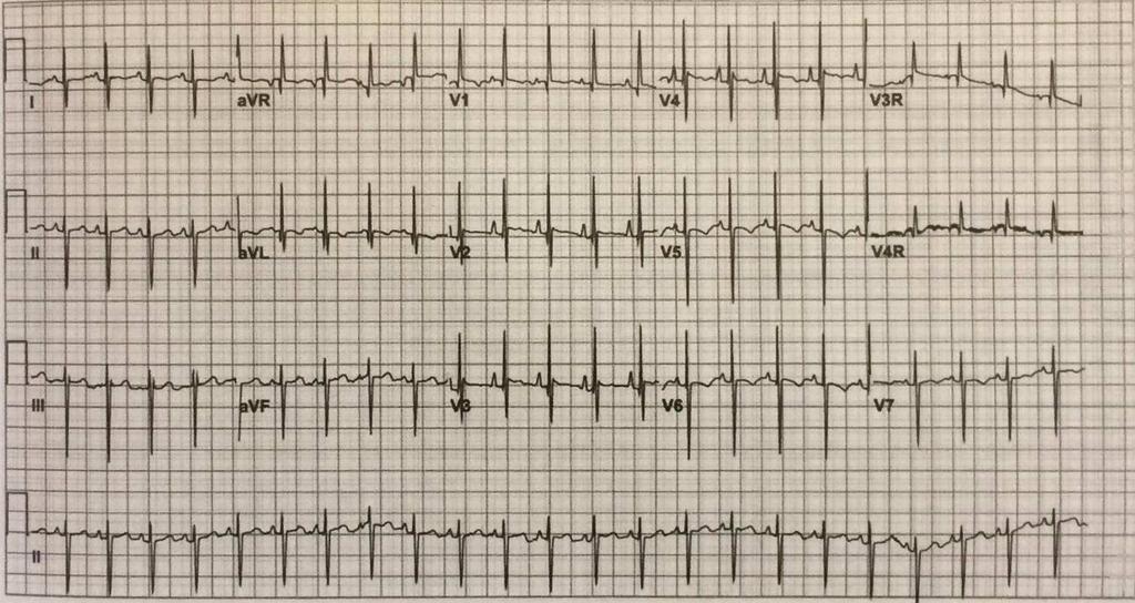 20. A atresia tricúspide é um exemplo de qual dos seguintes, considerando-se a análise sequencial? a) Conexão atrioventricular em via de entrada comum.