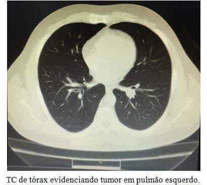 DISCUSSÃO A suspeita de tumor carcinoide pulmonar é levantada em pacientes que apresentam infecções pulmonares recorrentes, associadas à hemoptise, tosse ou sibilância.