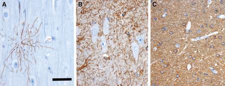 3 terciários com diagnóstico inicial de ELT farmacorresistentes (Cendes et al., 1993).