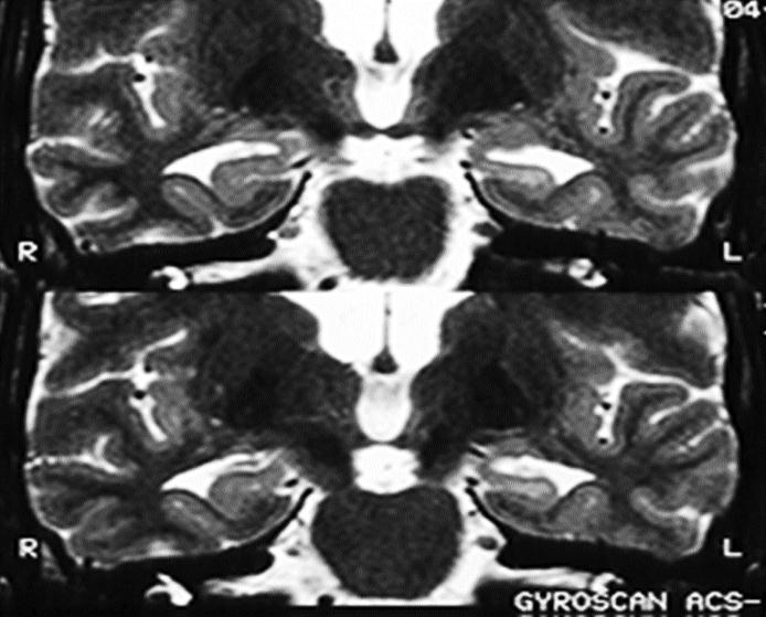 8 1.4.3 Aspectos de Neuroimagem A Ressonância Magnética (RM) é altamente sensível e específica no diagnóstico da EH.