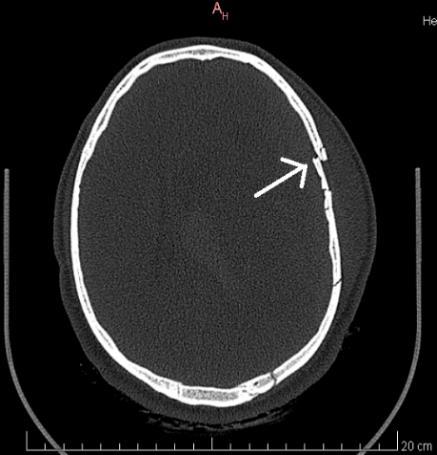 da deformação da abóbada craniana) ou associadas a afundamento local (quando o impacto é mais pontual). (46) Podem acometer tanto a calota óssea, como a base do crânio, como também os ossos da face.