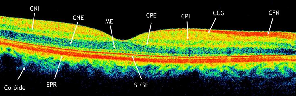 Figura 4. Representação de OCT macular de uma retina saudável. (Adaptado de (29)). Nesta imagem é possível identificar as dez camadas da retina.