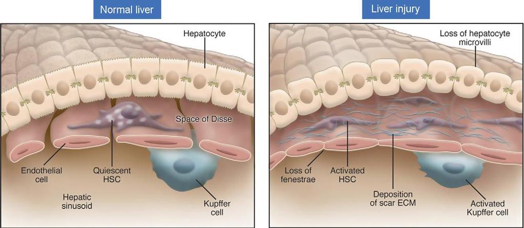 processo leva à fibrogênese hepática, que por consequência resulta na desestruturação do tecido e perda de sua funcionalidade.