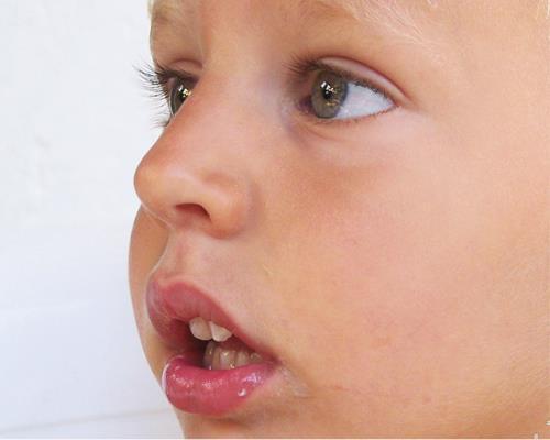 Respiração bucal Hipertrofia adenoideana: maior desenvolvimento do tecido linfoide; face adenoideana Hipertrofia amigdaliana Desvio de septo