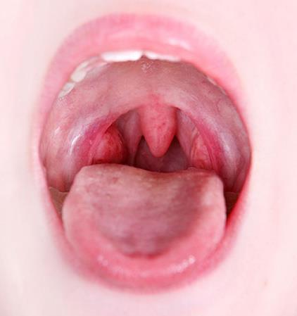 Adenoamigdalite Aspecto das tonsilas: Ulcerosa: úlceras rasas (herpes vírus ou coxsackie vírus) ou profundas Gangrenosa