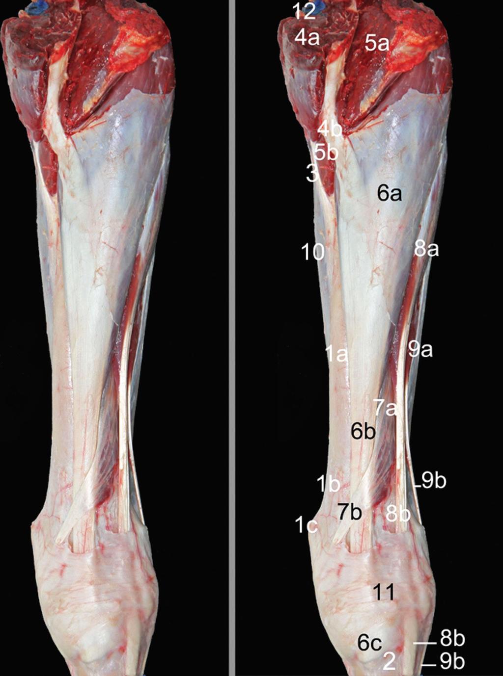 Lacertus fibrosus (Aponeurose bicipital) O músculo é dividido distalmente em uma parte lateral e outra medial.