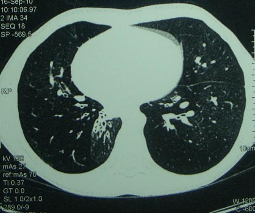 QUESTÃO 23 QUESTÃO 25 A doença da arranhadura do gato é considerada uma das principais causas de adenomegalia isolada crônica, que persiste por mais de três semanas em crianças.