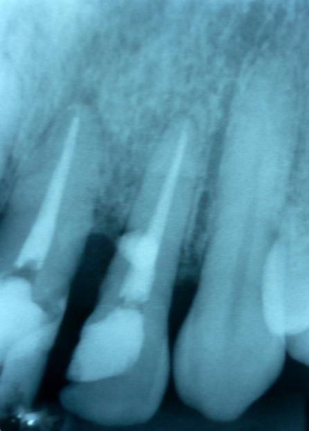 A radiografia de proservação após um ano pode ser vista na Figura 6.