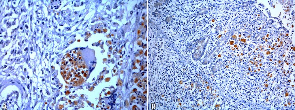 854 Luiz G.S. Oliveira et al. was a multifocal submucosal pyogranulomatous infiltrate with ulceration of the mucosa.