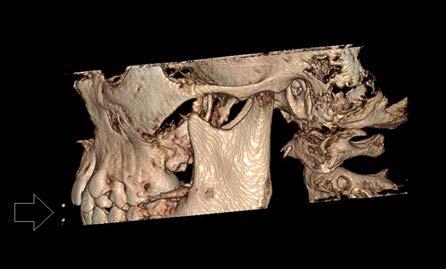 Capítulo II Eames Complementares na Identificação 43 Figura II.7 - Reconstrução tridimensional de imagens DICOM de CBCT.