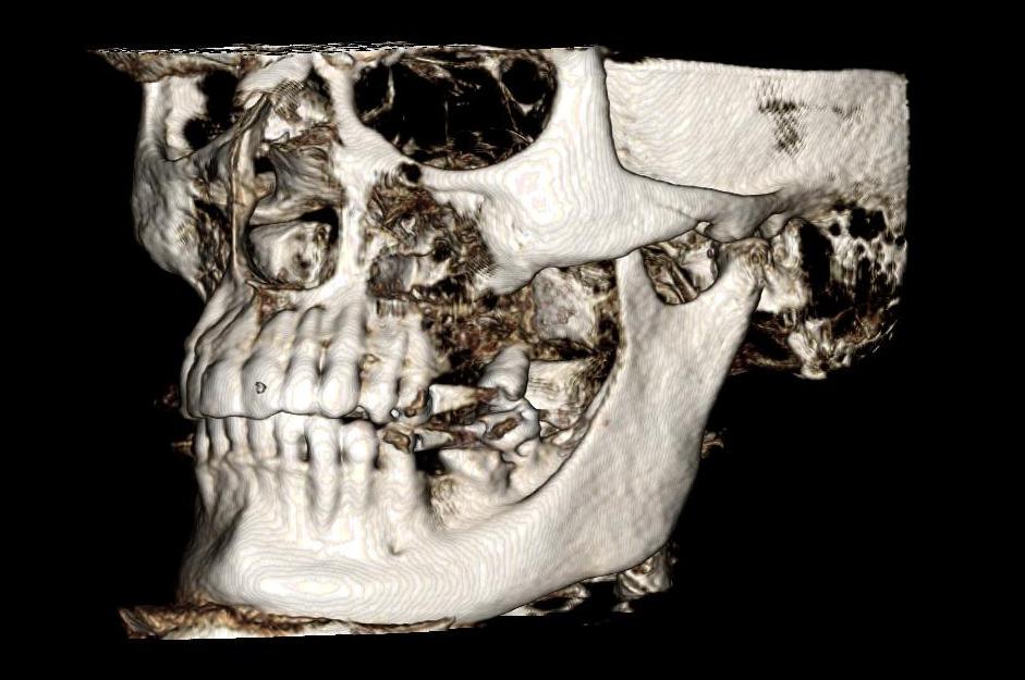 Nas reconstruções tridimensionais é possivel a caracterização de estruturas com diferentes radiopacidades e formação de imagens de melhor caracterização interindividual (fig. II.7, II.8 e II.9).