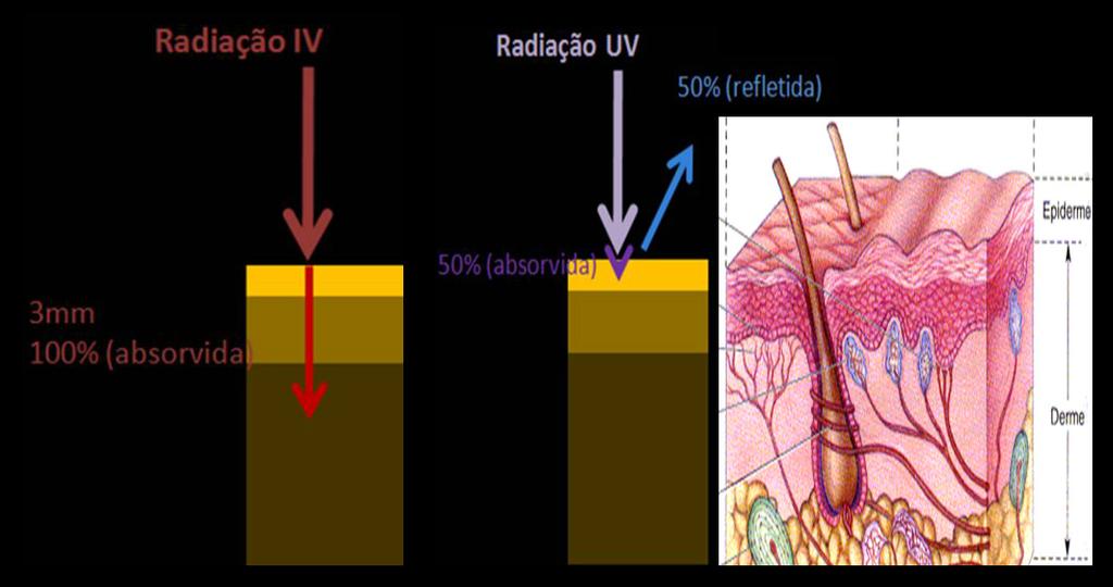 Capítulo II Eames Complementares na Identificação 47 Figura II.12 Representação esquemática da eposição da radiação infravermelhos (IV) e ultravioleta (UV) sobre a pele.