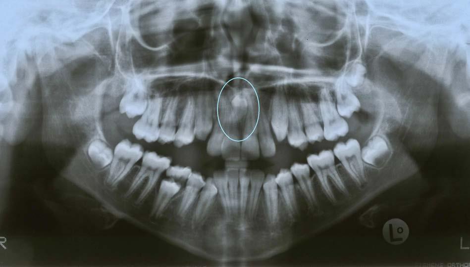 Capítulo II Eames Complementares na Identificação 37 Figura II.2 Ortopantomografia de um indivíduo do género feminino, com 13 anos de idade.
