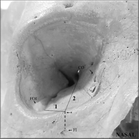 4 Figura 3. Mensuração da parede inferior. FI = forame infraorbitário, FOI = fissura orbital inferior, CO = canal óptico. * = rima orbital acima do forame infraorbitário.