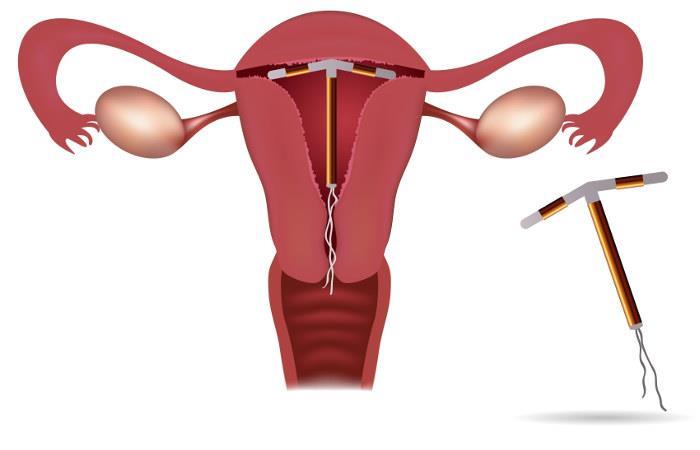 O DIU é colocado no interior do útero. Sistema Intrauterino Liberador de Levonorgestrel (SIU-LNG ou Mirena ): difere-se do DIU com cobre por liberar o hormônio levonorgestrel no interior do útero.
