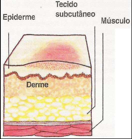 17. QUEIMADURAS São lesões produzidas no tecido de revestimento por agentes térmicos (calor, frio e eletricidade), produtos químicos corrosivos e irradiações.