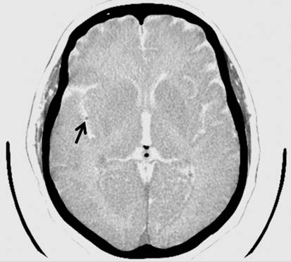 Em, observa-se aumento na densidade no segmento M1 da artéria cerebral média esquerda devido a trombose (seta). Tal achado é um dos sinais precoces de infarto cerebral.