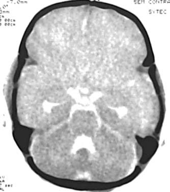 Figura 13. Imagem de TC no plano axial sem contraste de um paciente de 18 meses de idade com história de quase afogamento.