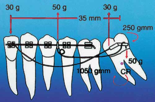 serção nos braquetes e verticaliza o molar com o fulcro na raiz distal.