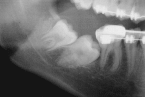 correta posição leva à normalização da situação oclusal funcional e