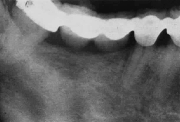 dentes inferiores no desenvolvimento pós-natal.