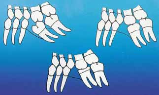 A manutenção do terceiro molar poderá prevenir o deslocamento distal do segundo molar e a abertura do espaço mesial ao segundo molar durante a verticalização 7, 16,19. FIG. 10 e 11.