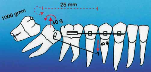 O comprimento do cantilever, longo ou curto, interferirá no momento do molar. Quanto mais curto o braço do cantilever (FIG.