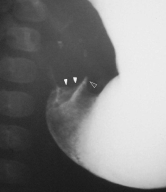 Figueirêdo SS et al. Figura 3. Sinal do ombro: impressão convexa da musculatura pilórica no antro gástrico. Nota-se um ombro superior mais proeminente que o inferior (pontas de setas brancas).