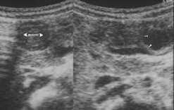 Sinal do ombro. Impressão do músculo pilórico hipertrofiado sob a parede distal do antro gástrico, enfatizado durante a peristalse gástrica (2) (Figura 12). 5. Sinal da cérvice.