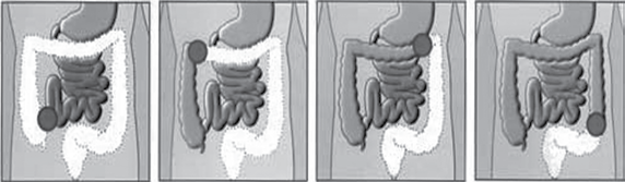 A ostomia intestinal e urinária tem uma coloração rosada, brilhante e úmida e a pele ao seu redor deve estar lisa sem vermelhidão.