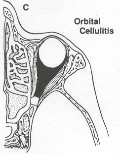 Ocorre obstrução do sistema de drenagem venosa das pálpebras levando a edema inflamatório. Não há limitação da movimentação ocular ou comprometimento da acuidade visual.