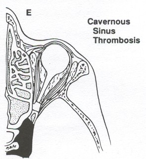 Grupo 5 (Trombose de Seio Cavernoso): a infecção pode se expandir para o seio cavernoso, devido à ausência de válvulas nas veias orbitárias.