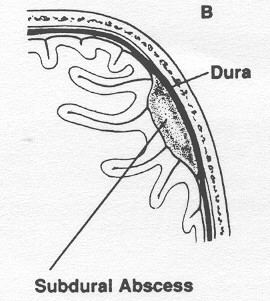 No empiema subdural somente as grandes coleções provocam efeito de massa levando ao aparecimento de quadro clínico evidente.