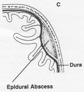 Figura 5: afecções intracranianas que podem ser causadas por rinussinusopatias, em relação à duramáter: A. abscesso intraparenquimatoso, B. abscesso subdural, C. abscesso epidural.