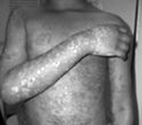 Caramez C, Di Giácomo CG, Schmidt LF e col. ratória. Há então aumento do nível sérico de porfirinas e seu depósito na pele, que com a fotoexposição, geram as lesões cutâneas 16.